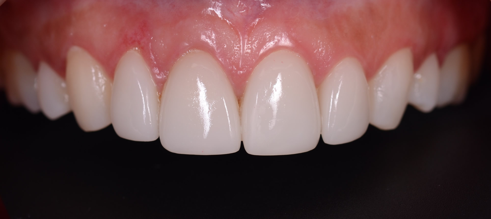 Después: Tratamiento con carillas cerámicas donde se mejora la apariencia, textura, color y estética de los dientes frontales superiores.