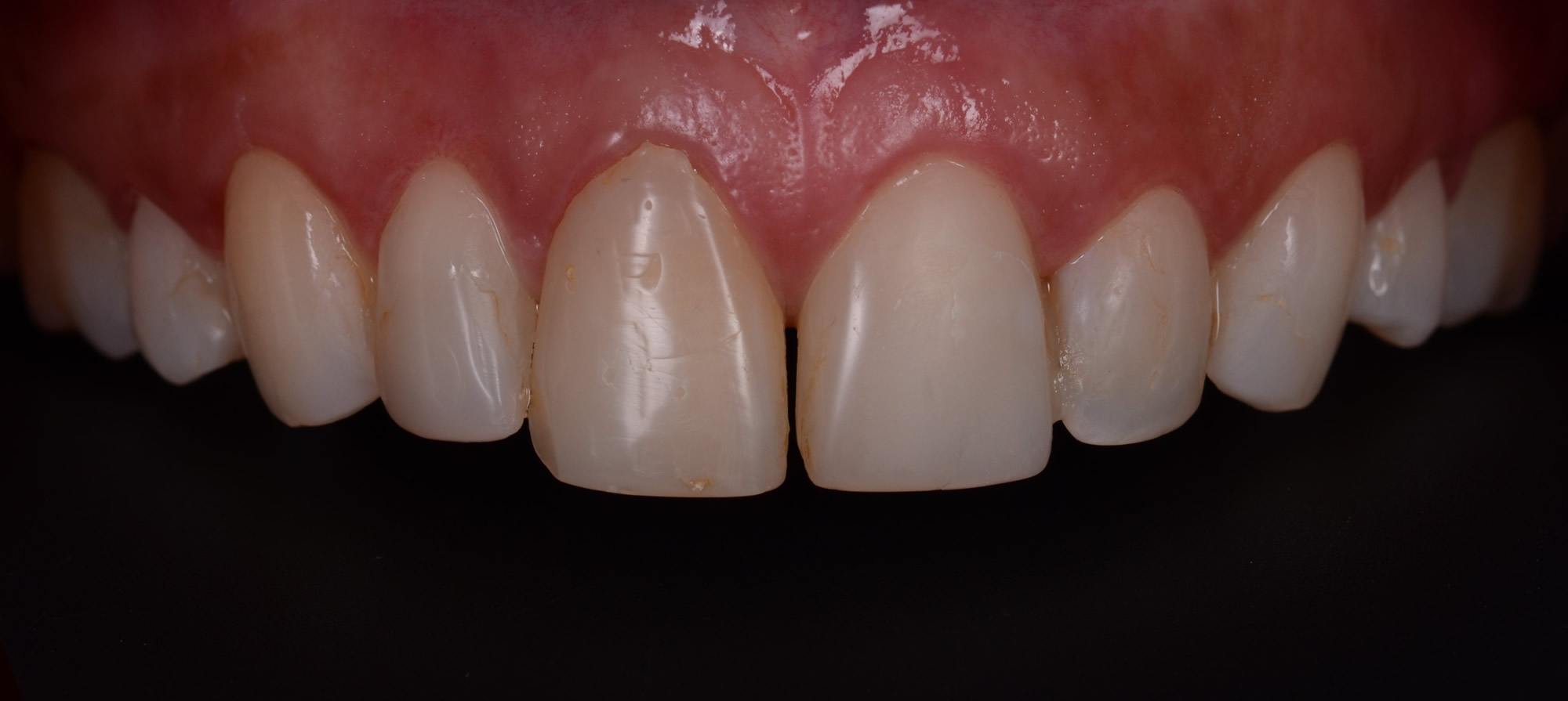 Antes:paciente consulta por que quiere cambiarse las resinas antiguas por un material que no se pigmente y quiere cerrar el espacio entre los dientes.