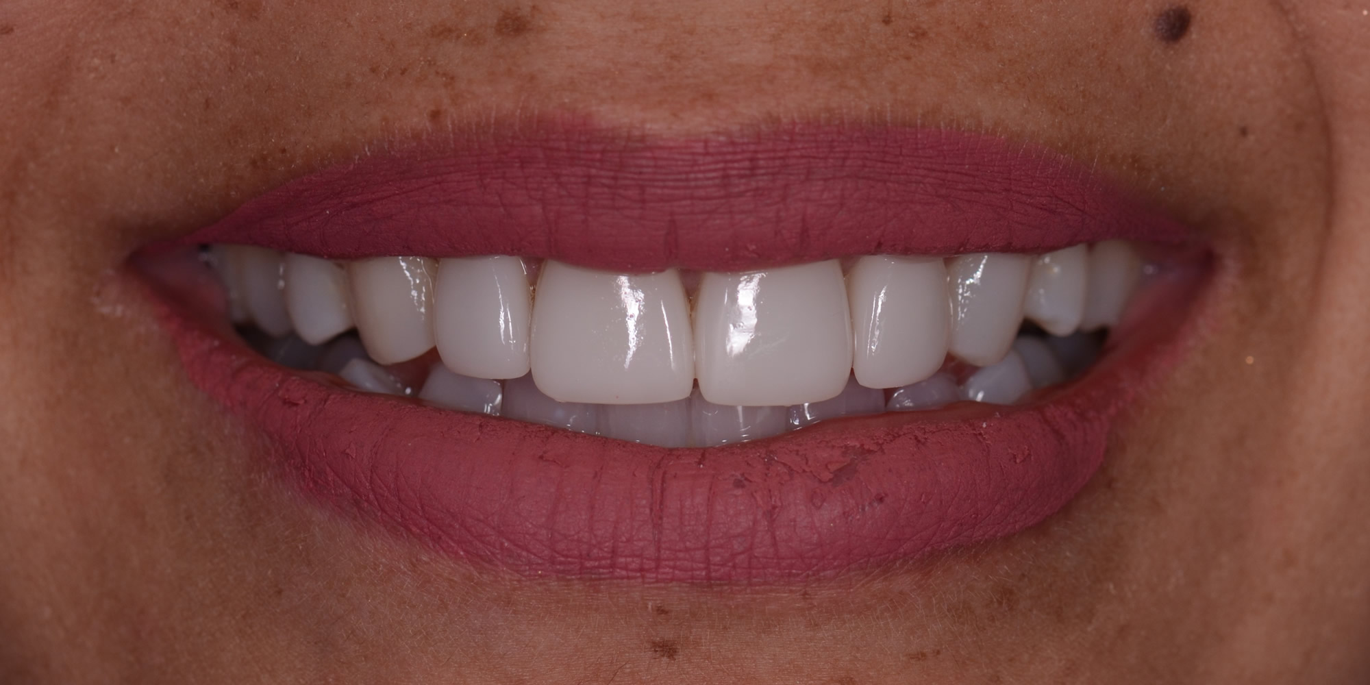 Después: tratamiento con carillas cerámicas donde se mejora la apariencia, textura, color y estética de los dientes frontales superiores.