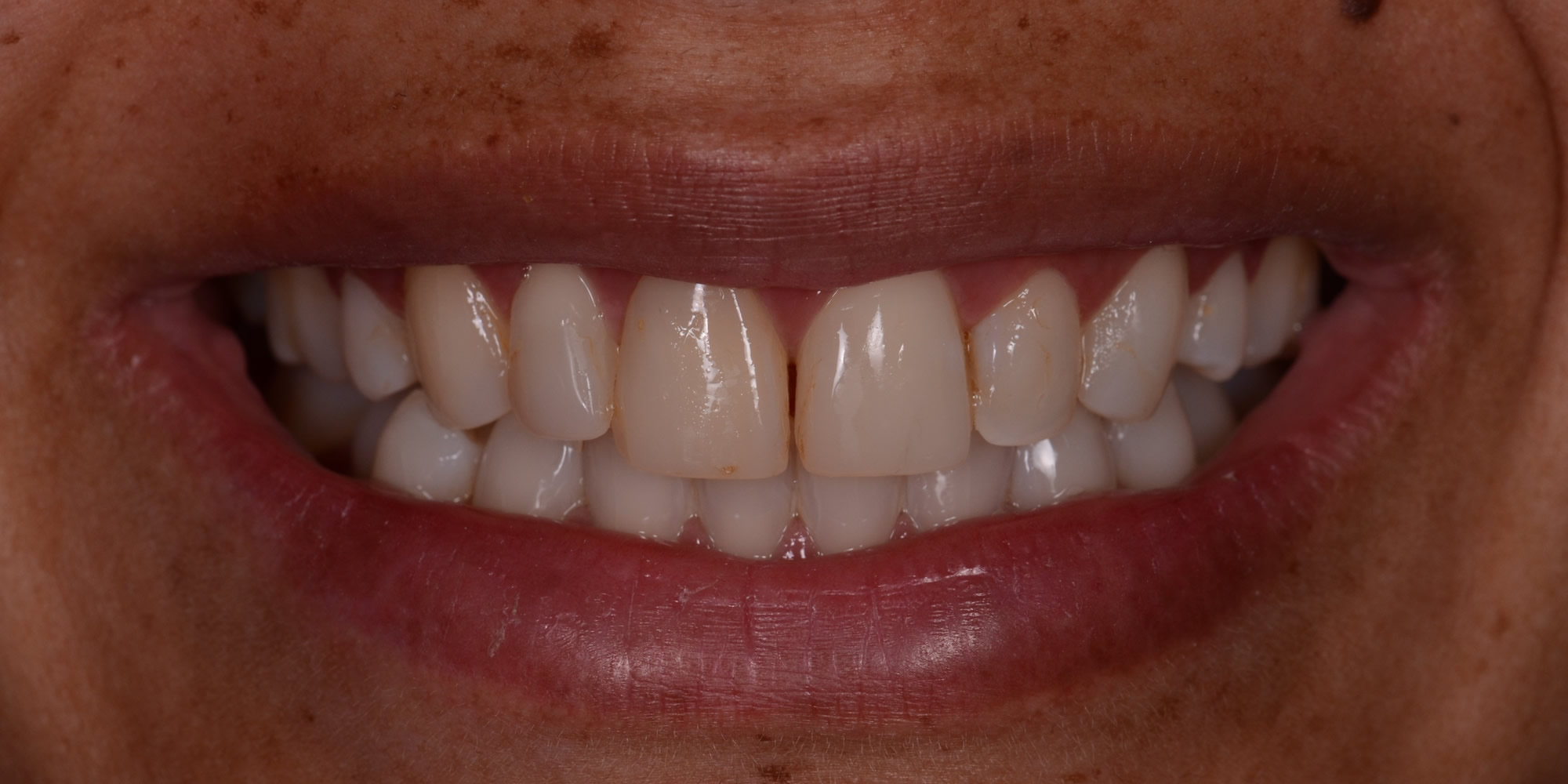 Antes:paciente consulta por que quiere cambiarse las resinas antiguas por un material que no se pigmente y quiere cerrar el espacio entre los dientes.